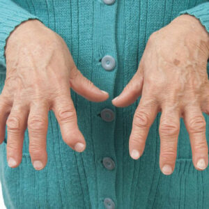 Types of arthritis and ways to deal with them