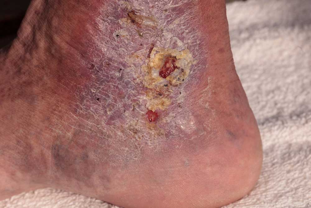 Causes and Symptoms of Cellulitis