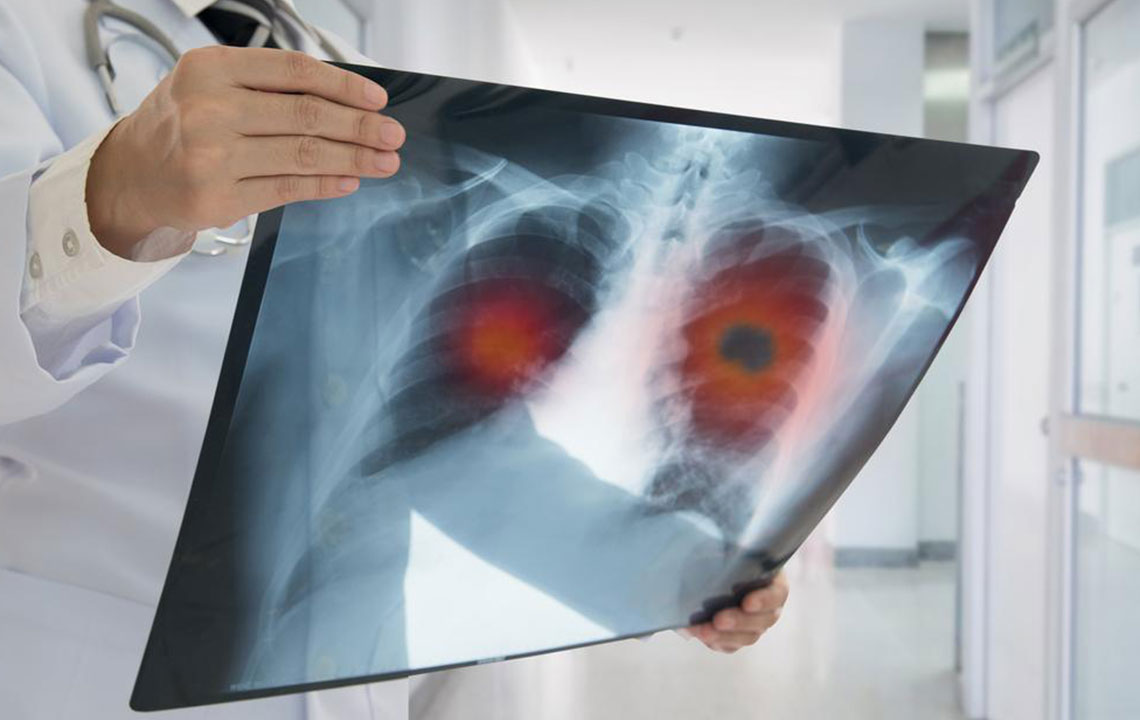 Popular treatment options for metastatic lung cancer